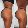 Comparativa de glúteos antes y después del uso de Vibro Sculpt mostrando firmeza y tonificación